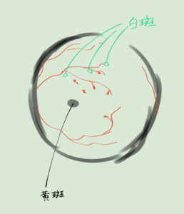 眼底図解 糖尿病網膜症